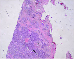 Carcinoma lobulillar metastásico de mama infiltrando el tejido pancreático (flecha) cerca de un conducto excretor (asterisco).