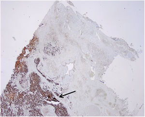 Carcinoma lobulillar infiltrante de mama en el tejido pancreático que expresa GATA3 nuclear (flecha).