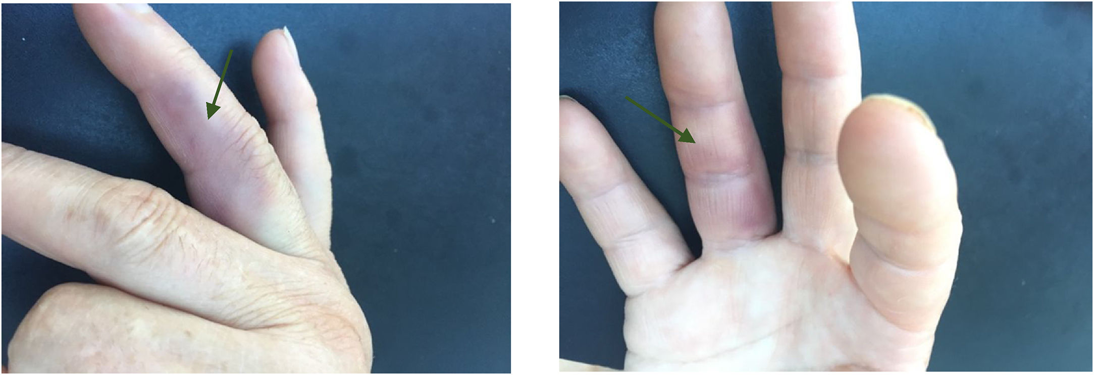 Achenbach Paroxysmal finger haematoma: A case of Achenbach's syndrome | Medicina ...