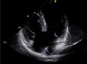 Echocardiography: complete atrioventricular septal defect, reduced vertex inter-ventricular communication, wide communication inter-atrial (arrow).