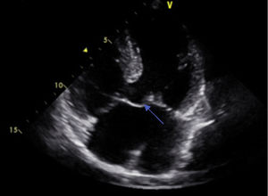 Echocardiography: a single atrioventricular valve (arrow).