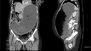 CT scan of the abdomen that revealed asymmetric thickening of the gastric antrum, dilation of the stomach up to the greater pelvis at the expense of intraluminal mass with a mottled pattern composed by the presence of gastric material and gas, as well as displacement of the intestinal loops to the right hemiabdomen.
