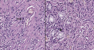 Left image: In the lower-left area is observed the presence of malignant epithelial cells that infiltrate through the smooth muscle bundles, intermingled with chronic inflammatory cells; in the center of the image there is mitosis (Arrow, original magnification to 40X). Right image: There are residual glands which are displayed on the left side of the image (asterisk).