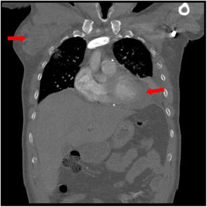 Caso 1: Tomografía computarizada (TC) torácico diagnóstico, corte coronal. Se objetivan masa axilar derecha, adenopatías mediastínicas múltiples, derrame pleural izquierdo con atelectasia pasiva de lóbulo inferior y língula, masa en ángulo cardiofrénico anterior izquierdo, que contacta y muestra mal plano de clivaje con pericardio y hemidiafragma.