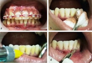 (a) Initial intraoral photos. Miller's Class I gingival recession in #31; (b) disinfection in the operating area; (c) local anesthesia with infiltration in region #32–41; (d) papilla preservation incisions from mesial #32 to mesial #41 using scalpel no. 15.