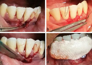 (a) Open flap using the periosteal elevator; (b) flap is positioned coronally and sutured with sling sutured; (c) vestibulectomy using scalpel no. 15; (d) periodontal dressing placement to cover the surgical wound.