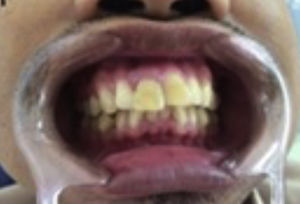 Clinical appearance of teeth #11.