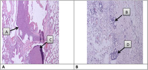 Histopathological features of tumor tissue after DMBA induction. (A) Histopathology picture of lung organ that has positive cancer (lung carcinoma). (B) Histopathology picture of breast organ that has positive cancer (invasive Ductal Carcinoma).