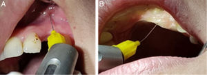 (A) Local infiltration technique. (B) Palatal local aesthetic.