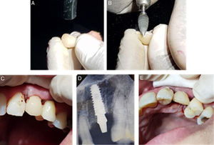 (A) A chairside provisional crown on #23 with composite resin material. (B) Shaping and polishing #23 temporary crown. (C) Labial aspect the provisional crown after suturing procedures. (D) Periapical radiography, show the position of the implant and rigid abutment after provisional crown loading and suturing procedures (E).