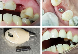 (A) Gingival margin profile from labial view after 9.5 weeks. (B) Occlusal view of gingival emergence profile. (C) Screw retained final prosthetic. (D) Labial view of Screw retained final prosthetic insertion, show a good gingival margin and a little black triangle.