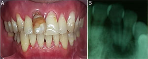 (A) Intra oral image before treatment (frontal view), (B) periapical radiography. Case management.