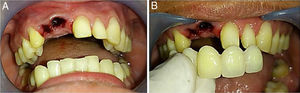 (A) Post extraction condition and (B) the installation of provisional bridge prostheses.