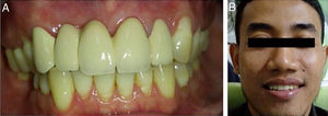 (A) Control 1 month later. (B) Extra oral image after installation of the fixed bridge prostheses.