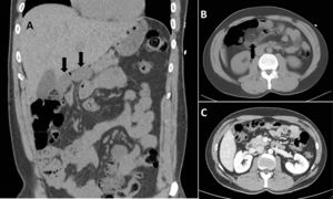 A) TC de abdomen sin contraste en reconstrucción coronal donde se evidencia las asas del intestino delgado contiguas al hígado (flechas). B) Corte transversal con asas de intestino delgado localizadas en hipocondrio derecho anteriores al ángulo hepático del colon y al duodeno, adyacentes al lóbulo hepático izquierdo no presente en TC de abdomen previo (flecha). C) TC de abdomen normal previo.