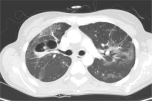 Cavitación del parénquima pulmonar en contacto con arteria pulmonar ipsilateral.