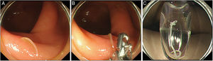 Colonoscopy revealed a mobile whitish object among the folds, with extremely strong adherence to the mucosa of the ascending colon (A). The nematode was extracted using forceps (B) and identified as a 20-mm long Anisakis spp. (C).