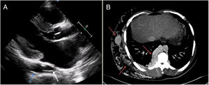 A) Ecocardiografía transtorácica plano paraesternal largo. B) Tomografía computerizada abdominal corte axial.