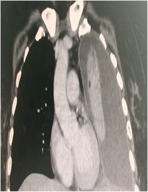 Tomografía contrastada de tórax en corte coronal que demuestra colapso pulmonar izquierdo con derrame pleural masivo.