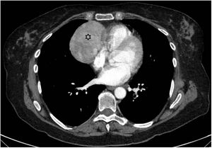 Imagen transversal de TC de tórax con contraste, donde se objetiva una lesión ovalada de 8 cm de diámetro anteroposterior en mediastino anterior con cierta compresión de cavidades derechas, compatible con timoma (asterisco).
