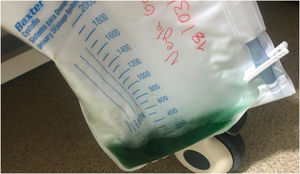Orina verde por infusión de propofol.