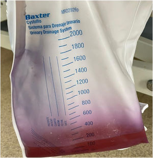 Orina púrpura por infección por Klebsiellaspp.