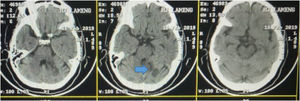 The result of head CT scan without contrast. There were multiple hypodense lesion on the left cerebellum (19HU). In addition, there were also hypodense lesion on the left mesencephalon. The hypodense lesion indicates an ischemic stroke in that area.