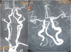 The result of head and neck CT scan-angiography with contrast. There were multiple atherosclerotic plaque at Anterior Cerebral Artery dextra, Carotis Communis Artery Sinistra, Internal Carotid Artery Dextra et Sinistra, Vertebralis Artery, Basillaris Artery, and Posterior Cerebral Artery.