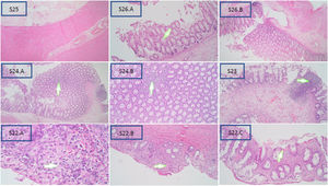 Representative of a sample with histopathological HAEC rank (hematoxylin–eosin staining, 4×).