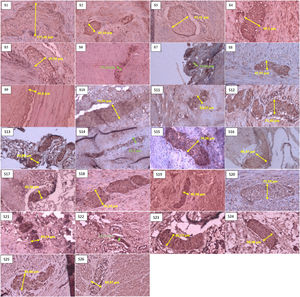 Sample of neural hypertrophy diameter measurement using S-100 immunohistochemistry, with 40× magnification. The green line shows the diameter of a nerve that does not experience hypertrophy (nerve diameter<40μm). In comparison, the yellow line shows the diameter of a nerve that experiences hypertrophy (nerve diameter≥40μm).