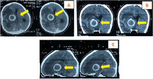 Head CT scan (A). Axial cuts with contrast appear rim enhanced on the right frontotemporal accompanied by extensive perifocal edema causing subfalcine herniation. (B) Coronal cut. (C) Sagital cut, contrast enhanced lesions appears in the Pons.