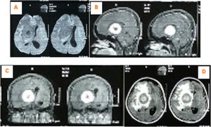 MRI brain (A). Axial cut without contrast. (B) Sagital cut with (C). Coronal cut with contrast (D) Axial cut wit contrast.