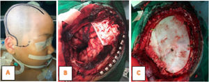 Intraoperative Photograph: (A) Question mark incision. (B) Open the dura mater and proceed with tumor removal. (C) Craniotomy was performed.