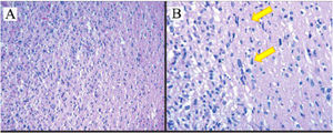 Histopathology results of astrocytoma tumors show tumor cells diffusive infiltration into the brain parenchyma with atypical nucleus, pleomorphic, coarse chromatin and partially with prominent nucleoli. (A) Hematoxylin–eosin staining, 10×. (B) Hematoxylin–eosin staining 100× (yellow arrow showed astrocyte cells with bizarre nuclei).