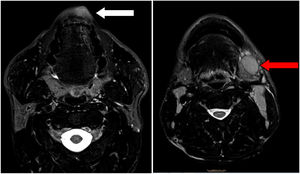 Imágenes de resonancia magnética que muestran el infiltrado en el labio inferior (flecha blanca) y la presencia de adenopatía cervical izquierda (flecha roja).