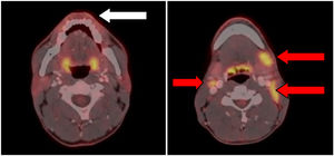 Imágenes de PET-TC que muestran captación de fluorodesoxiglucosa F-18 (18F-FDG) en úlcera del labio inferior (flecha blanca) y la captación en adenopatías bilaterales (flechas rojas).
