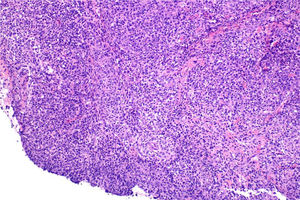 Biopsia de lesión labial (H-E, 4×). Lesión ulcerada con marcado componente inflamatorio.