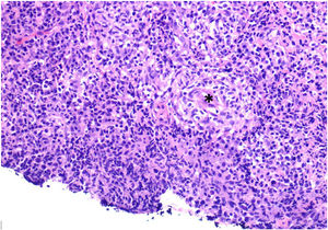 Biopsia de lesión labial (H-E, 20×). Granuloma no necrosante (*).