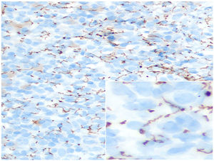 Biopsia de lesión labial. La tinción inmunohistoquímica para espiroquetas (40×) pone en evidencia estructuras enrolladas remedando un sacacorchos.