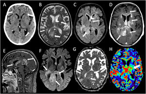 Múltiples lesiones hiperintensas en T2 (B) que de forma parcialmente confluente y expansiva afectan bilateralmente la sustancia blanca subcortical bifrontal, los centros semiovales y la corona radiata, la región gangliobasal y la sustancia blanca periventricular. También compromiso de la sustancia blanca profunda posterior del lóbulo temporal derecho. Las lesiones comprometen extensamente el cuerpo calloso en toda su extensión, el fórnix derecho, la comisura blanca anterior, cintillas ópticas bilaterales, el hipocampo derecho y el pedúnculo y tegmento mesencefálico izquierdo. Las lesiones tienen discreta hiperseñal a la difusión (F), y presentan un realce homogéneo y mal definido después de la administración del contraste (D,E). En el estudio de perfusión, alguna de las lesiones muestra aumento del volumen sanguíneo cerebral (H).