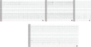 Vídeo-EEG continuo. Montaje referencial (average). LFF 0,5 Hz, HFF 70 Hz, sensibilidad 20 μV/mm, barrido 15 mm/seg. Estado epiléptico focal con crisis electroclínicas durante > 10 min, con una prevalencia > 20% de la totalidad del registro (> 60 min). Selección de 3 épocas de registro de: A) 20 s; B) 12 s; y C) 7 s, que muestran un patrón crítico prácticamente continuo caracterizado por la sucesión de anomalías epileptiformes, de elevada amplitud y proyección topográfica, que muestran cambios secuenciales de morfología, frecuencia y distribución en regiones temporo-parieto-occipitales de hemisferio derecho (A y B). Patrón discontinuo tras la administración de DZP y LEV (C). D) Vídeo-EEG (UCI). Montaje referencial (average). LFF 0,5 Hz, HFF 70 Hz, sensibilidad 20 μV/mm, barrido 15 mm/seg. Remisión del estado epiléptico tras sedación (MDZ y RMF). Persisten ocasionales anomalías epileptiformes intercríticas en las regiones témporo-parieto-occipitales derechas (P8, O2).