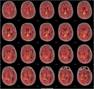 PET-TC cerebral con 18F-FDG, cortes axiales. Múltiples focos hipermetabólicos en ambos hemiferios afectando a la sustancia blanca subcortical bifrontal, de los centros semiovales, de los núcleos de la base y de la corona radiada, así como la sustancia blanca periventricular, sustancia blanca del lóbulo temporal derecho. Marcado hipermetabolismo en todo el cuerpo calloso, fórnix derecho, comisura blanca anterior, cintas ópticas bilaterales, hipocampo derecho y pedúnculo cerebral izquierdo, la más destacable por su metabolismo localizada en el fórnix derecho. Hallazgos sugestivos de un proceso infiltrativo tumoral (alto grado).
