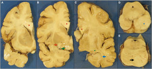 Imágenes macroscópicas de secciones coronales del hemisferio izquierdo (A, B), del hemisferio derecho (C), del mesencéfalo (D) y protuberancia (E). Se observa un engrosamiento del cuerpo calloso (A, B y C, asterisco rojo), de la comisura blanca anterior (B, flecha roja) y de las cintillas ópticas (B, flecha verde), afectación del cuerpo geniculado lateral (C, asterisco verde) y lesión nodular en la cabeza del hipocampo posterior derecho (C, flecha azul). Lesión nodular en mesencéfalo (D, asterisco azul) y en hemiprotuberancia izquierda (E, flecha negra).