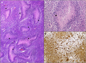 Imágenes histológicas de la lesión. A) Lesión densamente celular con frecuentes focos de necrosis serpinginosa (hematoxilina-eosina, 40×, asteriscos negros en áreas de necrosis). B) A mayor aumento se observa cariorrexis y necrosis central, con seudoempalizada, asterisco negro (hematoxilina-eosina, 200×). C) Estudio inmunohistoquímico de proteína glial acídica en el que se observa una expresión parcheada de la proteína (GFAP, 200×).