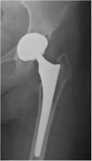 Prótesis total de cadera izquierda, con componentes femoral y acetabular no cementados. Par de ficción cerámica-cerámica.