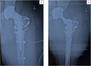 Imagen radiológica que muestra el espaciador articulado prefabricado en primer tiempo de recambio de cadera. B) Imagen radiológica que muestra la prótesis de revisión en segundo tiempo de recambio de cadera.