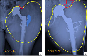 La línea roja muestra la osteolísis del acetábulo; la línea amarilla identifica la lesión tumoral de partes blandas periprotésica; y el área azul señala el trocánter mayor del fémur. A). Mayor aumento de la masa tumoral, lesión osteolítica del acetábulo y aún persistencia del trocánter mayor. B). Transcurridos 2 meses, se observa lisis completa del trocánter mayor (ausencia de área azul), aumento del tumor de partes blandas y mayor lisis del fémur proximal.
