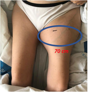 Imagen clínica de la masa tumoral del tercio proximal del muslo izquierdo de 70 cm de diámetro.