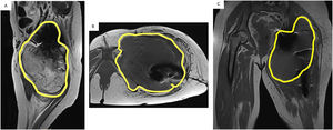 Imágenes de los cortes sagital (A), axial (B) y coronal (C) de la RMN que revelan una masa tumoral periprotésica de cadera izquierda con tamaño de 20 × 15 × 16 cm identificada en la imagen mediante el espacio comprendido por dentro de la línea amarilla.