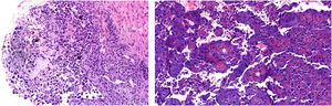 A) Imagen histológica de la lesión. Marcada celularidad atípica (→). Hematoxilina-eosina, 400×). B) Imagen histológica de la lesión. Patrón papilar (*) con celularidad atípica (→). (Hematoxilina-eosina, 400×).
